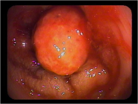 anal polyp photographs Lesbian titty fuckera videos